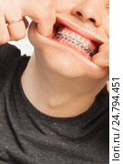Young man with orthodontic cases having fun. Стоковое фото, фотограф Сергей Новиков / Фотобанк Лори