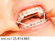 Putting orthodontic ring strings on teeth braces. Стоковое фото, фотограф Сергей Новиков / Фотобанк Лори