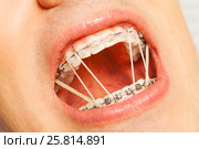 Open man mouth with braces and orthodontic rings. Стоковое фото, фотограф Сергей Новиков / Фотобанк Лори