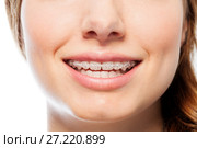 Happy woman's smile with orthodontic clear braces. Стоковое фото, фотограф Сергей Новиков / Фотобанк Лори