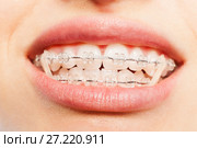 Teeth with dental braces and elastics full mouth. Стоковое фото, фотограф Сергей Новиков / Фотобанк Лори