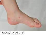 Enterovirus Leg arm mouth Rash on the body of a child Cocksackie virus. Стоковое фото, фотограф Irina Kuchugurina/Gaudy / Фотобанк Лори