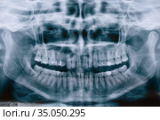 Panoramic shot of the jaw. Panoramic black and white image dental x-ray of adult without single dental implant. Roentgen teeth upper and lower jaw. Negative shot. Стоковое фото, фотограф Nataliia Zhekova / Фотобанк Лори