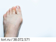 A woman's leg, protrudes a bone it hurts to walk in heels, a leg on a white background. Стоковое фото, фотограф Igor Bastrakov / Фотобанк Лори