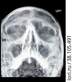Radiography of a human skull paranasal sinuses rhinosinusitis diagnostic sinusitis. Стоковое фото, фотограф Camptoloma / Фотобанк Лори