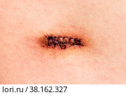 Row of stitches holding together the edges of a wound. Стоковое фото, фотограф Nobilior / Фотобанк Лори