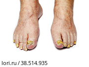 Fungal Nail Infection. Стоковое фото, фотограф Lekcej / Фотобанк Лори