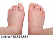 Two swollen legs. Стоковое фото, фотограф Lekcej / Фотобанк Лори