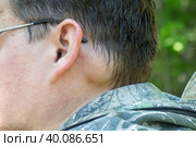 A benign tumor on a person's head behind the ear. Стоковое фото, фотограф Александр Поташев / Фотобанк Лори