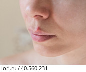 Cold sores. Close-up of the female face, selective focus. Стоковое фото, фотограф Саблин Станислав / Фотобанк Лори