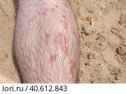 Part of a male leg with psoriatic plaques, covered with hair. Skin diseases in adults. Стоковое фото, фотограф Коханова Наталья / Фотобанк Лори