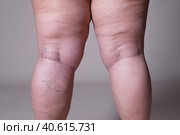Varicose veins closeup, fat female cellulite legs. Стоковое фото, фотограф Станислав Тарко / Фотобанк Лори
