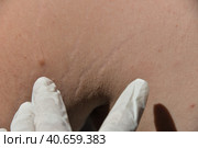 Skin diseases irritation, itching, cracked wounds lead to painful sensations. The skin may grow papillomas, warts, moles, white and dark spots will appear. Стоковое фото, фотограф Юлия Можина / Фотобанк Лори