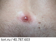 Abscess furuncle carbuncle on male hairy back. Clogged pore leading to skin inflammation. Surgical solution of cosmetic problems. Redness, swelling and pimple formation. Dermatology and surgery. Стоковое фото, фотограф Юлия Петровская / Фотобанк Лори