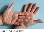 Painful rash, red spots blisters on hand. Close up Allergy rash, human hands with dermatitis Health problem. Eczema skin of patient. Viral Diseases. Стоковое фото, фотограф Марина Демидюк / Фотобанк Лори