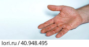 Male hands with Monkeypox rash. Patient with MonkeyPox viral disease. Close Up of Painful rash, red spots blisters on the skin. Human palm with Health problem. Banner, copy space. Allergy, dermatitis. Стоковое фото, фотограф Марина Демидюк / Фотобанк Лори