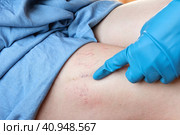 Phlebologist examines a patient with varicose veins on his leg. Leg pain. Phlebology. Venous pathologies of the lower extremities. Human vessel, arteries. Capillaries. Blood system. Health legs. Стоковое фото, фотограф Марина Демидюк / Фотобанк Лори