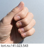 Fungal nail infection, onycholysis after shellac or gel-varnish. Стоковое фото, фотограф Татьяна Терехина / Фотобанк Лори