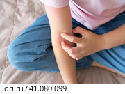 The child applies a special cream to atopic skin. Dermatitis, diathesis, allergy on the child's body. Стоковое фото, фотограф Терехова Марина / Фотобанк Лори