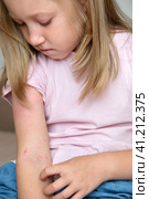 The child applies a special cream to atopic skin. Dermatitis, diathesis, allergy on the child's body. Стоковое фото, фотограф Терехова Марина / Фотобанк Лори