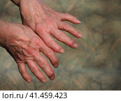 Close-up of an elderly woman's hands. Hands affected by osteochondrosis or arthritis of the joints on the fingers and wrinkled skin. Стоковое фото, фотограф Александр Кротков / Фотобанк Лори