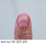 Forked nail on the thumb. Dilation of the nail, traumatic pathology. The nail is divided in half. Стоковое фото, фотограф Леонид Еремейчук / Фотобанк Лори