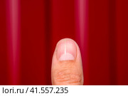 Forked nail on the thumb. Dilation of the nail, traumatic pathology. The nail is divided in half. Стоковое фото, фотограф Леонид Еремейчук / Фотобанк Лори