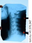 X-ray of the cervical vertebrae. X ray image of the cervical spine. Стоковое фото, фотограф Леонид Еремейчук / Фотобанк Лори