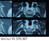 MRI sacroiliac articulation. Study of ankylosing spondyloarthritis patient. Стоковое фото, фотограф Леонид Еремейчук / Фотобанк Лори