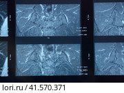 MRI sacroiliac articulation. Study of ankylosing spondyloarthritis patient. Стоковое фото, фотограф Леонид Еремейчук / Фотобанк Лори