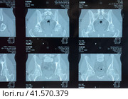 MRI sacroiliac articulation. Study of ankylosing spondyloarthritis patient. Стоковое фото, фотограф Леонид Еремейчук / Фотобанк Лори
