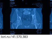 MRI sacroiliac articulation. Study of ankylosing spondyloarthritis patient. Стоковое фото, фотограф Леонид Еремейчук / Фотобанк Лори