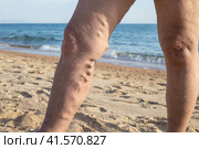 Female legs with varicose veins against the background of the sea. Spa treatment for sore legs. Стоковое фото, фотограф Коханова Наталья / Фотобанк Лори