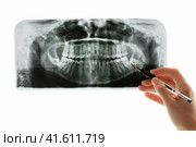 Close-up of panoramic dental scan. Radiologist hand points to problem area on X-ray. Стоковое фото, фотограф Светлана Ельцова / Фотобанк Лори