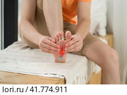 Joint diseases, hallux valgus, plantar fasciitis, man's leg hurts, pain in the foot. Стоковое фото, фотограф Станислав Тарко / Фотобанк Лори