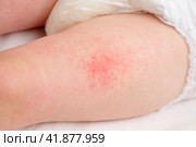 Allergic rash on the legs of the toddler baby boy. Red pimples from allergies on the child's body. Стоковое фото, фотограф Андрей Журавлев / Фотобанк Лори