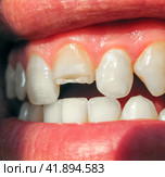 Broken tooth. Broken upper incisor in a man mouth. Стоковое фото, фотограф Леонид Еремейчук / Фотобанк Лори