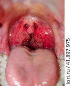 Open mouth with protruding tongue and inflamed tonsils. Throat of a person with the disease lacunar tonsillitis. Стоковое фото, фотограф Коханова Наталья / Фотобанк Лори