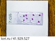 Slices of the tumor under glass. Histological examination of tumor cells for the presence of cancer. Стоковое фото, фотограф Леонид Еремейчук / Фотобанк Лори