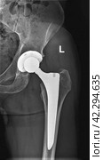 X-ray of left hip prosthesis. AP view. 12 weeks after total hip replacement. Стоковое фото, фотограф Татьяна Лобанова / Фотобанк Лори