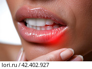 Young woman suffering from herpes on lips, health problems concept, AI Generated. Стоковое AI-изображение, AI-художник Станислав Тарко / Фотобанк Лори