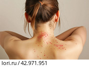 Female Back with Painful Rash, Red Spots Blisters on a Skin. Human Body with Health Problem. Monkeypox, Monkey Pox Disease Symptoms. Close Up Patient. Banner, Copy Space. Dengue Fever Infection, MPOX. Стоковое AI-изображение, AI-художник Марина Демидюк / Фотобанк Лори