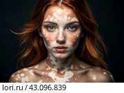 Leukoderma. Vitiligo. Violation of skin pigmentation. Large white spots all over the body and face. Portrait of a beautiful girl with a skin disease. Стоковое AI-изображение, AI-художник Photojuli / Фотобанк Лори