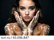 Leukoderma. Vitiligo. Violation of skin pigmentation. Large white spots all over the body and face. Portrait of a beautiful girl with a skin disease. Стоковое AI-изображение, AI-художник Photojuli / Фотобанк Лори