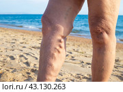 Sick female legs with thrombophlebitis and bumps, against the backdrop of the sea. Sanatorium and resort treatment for pensioners. Стоковое фото, фотограф Коханова Наталья / Фотобанк Лори