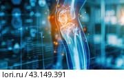 High-tech computer model of a leg with an inflamed knee joint. X-ray of the knee joint. Стоковое AI-изображение, AI-художник Александр Довянский / Фотобанк Лори