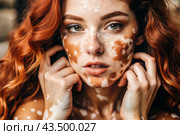 Leukoderma. Vitiligo. Violation of skin pigmentation. Large white spots all over the body and face. Portrait of a beautiful girl with a skin disease. Стоковое AI-изображение, AI-художник Photojuli / Фотобанк Лори