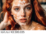 Leukoderma. Vitiligo. Violation of skin pigmentation. Large white spots all over the body and face. Portrait of a beautiful girl with a skin disease. Стоковое AI-изображение, AI-художник Photojuli / Фотобанк Лори
