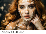Leukoderma. Vitiligo. Violation of skin pigmentation. Large white spots all over the body and face. Portrait of a beautiful girl with a skin disease. Стоковое AI-изображение, AI-художник Photojuli / Фотобанк Лори