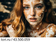 Leukoderma. Vitiligo. Violation of skin pigmentation. Large white spots all over the body and face. Portrait of a beautiful girl with a skin disease. Стоковое AI-изображение, AI-художник Photojuli / Фотобанк Лори